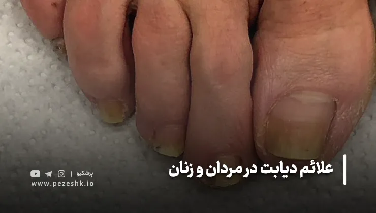 علائم دیابت روی ناخنها