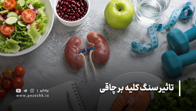 آیا بین سنگ کلیه و چاقی ارتباط وجود دارد؟