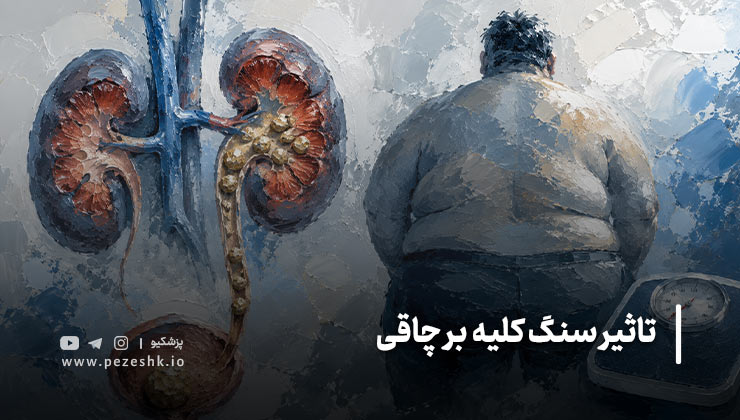 آیا کاهش وزن میتواند از سنگ کلیه جلوگیری کند؟