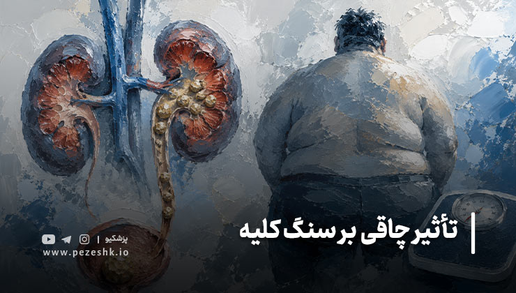 آیا همه افراد چاق دچار سنگ کلیه می‌شوند؟