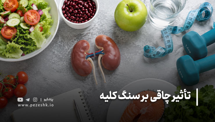 علائم سنگ کلیه در افراد دارای اضافه وزن