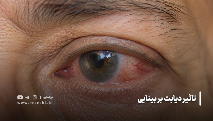 تاثیر دیابت بر بینایی