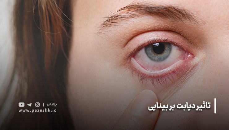 تاثیر دیابت بر بینایی