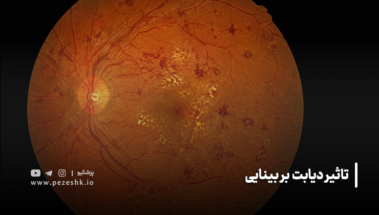 تاثیر دیابت بر بینایی